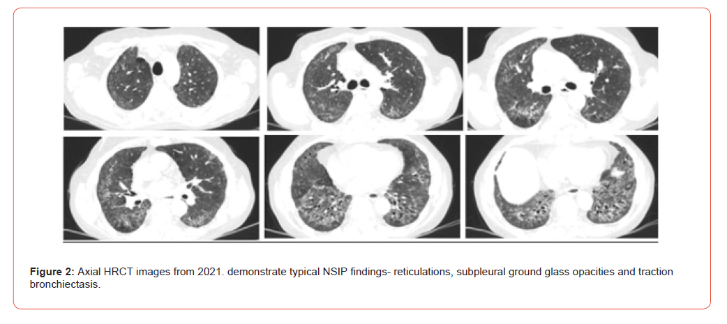 Click here to view Large Figure 2 irispublishers-openaccess-rheumatology-arthritis-research