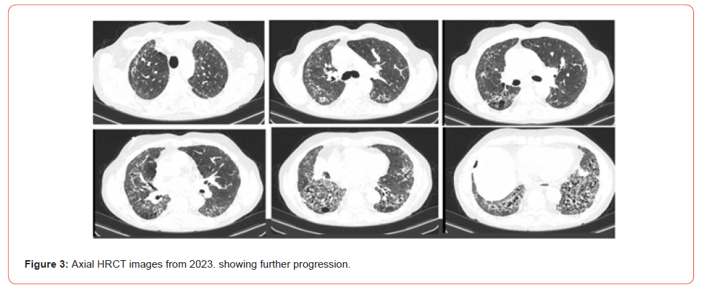 Click here to view Large Figure 3 irispublishers-openaccess-rheumatology-arthritis-research