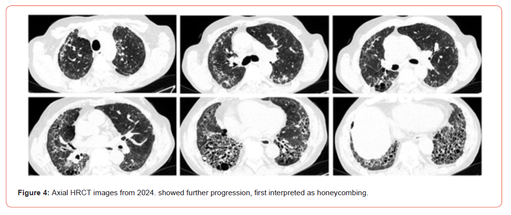 Click here to view Large Figure 4 irispublishers-openaccess-rheumatology-arthritis-research