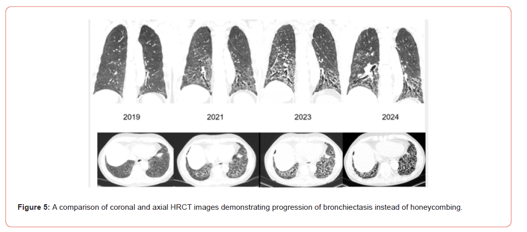 Click here to view Large Figure 5 irispublishers-openaccess-rheumatology-arthritis-research