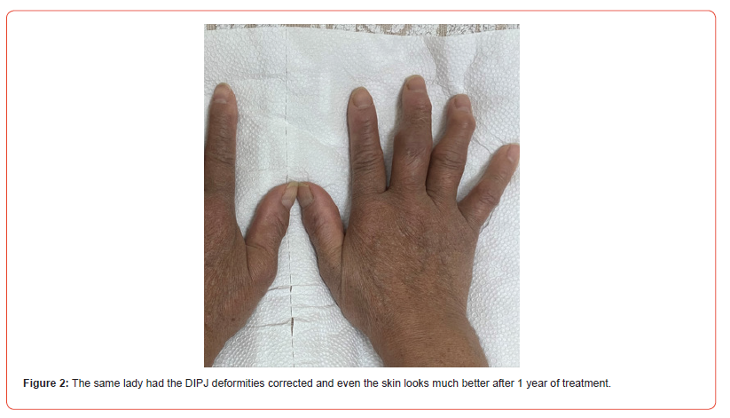Click here to view Large Figure 2 irispublishers-openaccess-rheumatology-arthritis-research