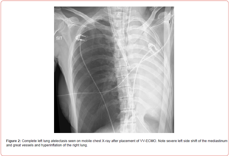 Click here to view Large Figure 2 irispublishers-openaccess-respiratory-pulmonary-medicine