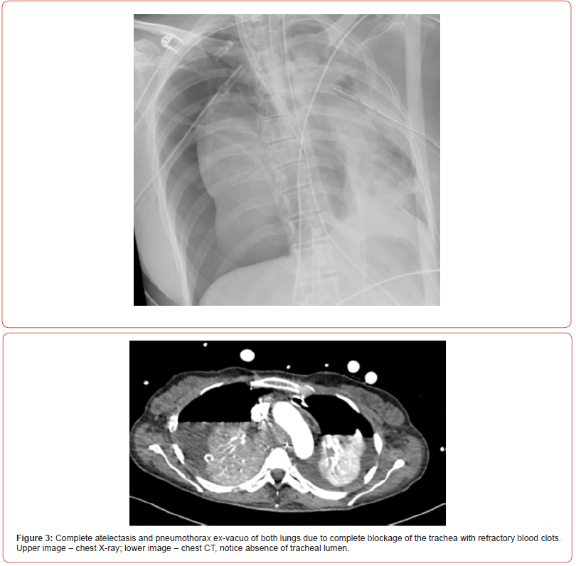 Click here to view Large Figure 3 irispublishers-openaccess-respiratory-pulmonary-medicine