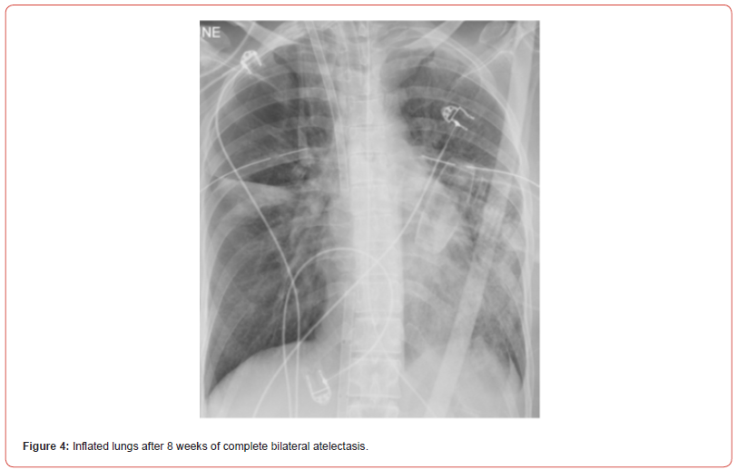 Click here to view Large Figure 4 irispublishers-openaccess-respiratory-pulmonary-medicine