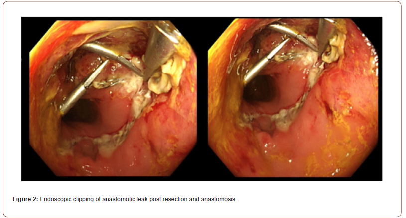 Click here to view Large Figure 2 irispublishers-openaccess-anaesthesia-surgery