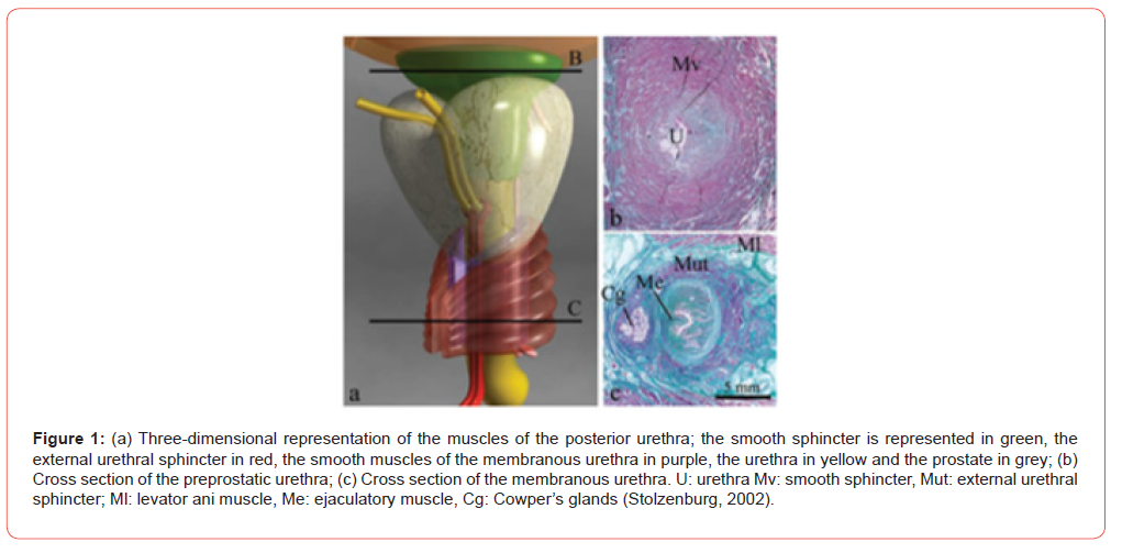 Click here to view Large Figure 1 irispublishers-openaccess-urology-nephrology