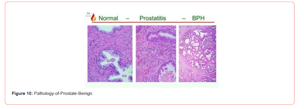Click here to view Large Figure 10 irispublishers-openaccess-urology-nephrology