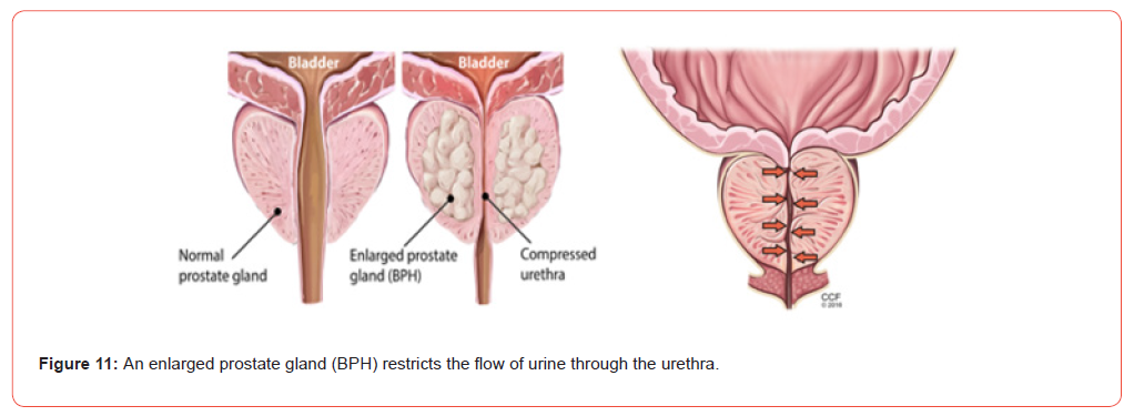 Click here to view Large Figure 11 irispublishers-openaccess-urology-nephrology