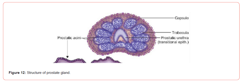 Click here to view Large Figure 12 irispublishers-openaccess-urology-nephrology