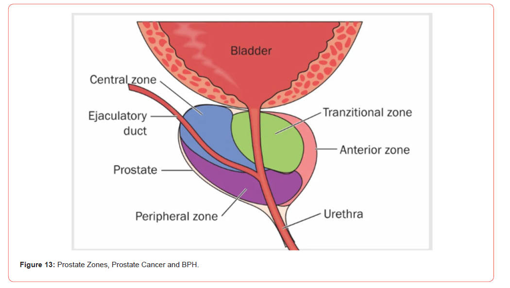 Click here to view Large Figure 13 irispublishers-openaccess-urology-nephrology