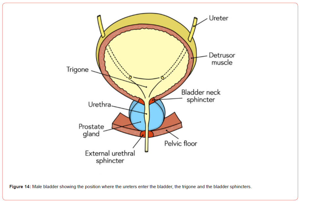 Click here to view Large Figure 14 irispublishers-openaccess-urology-nephrology