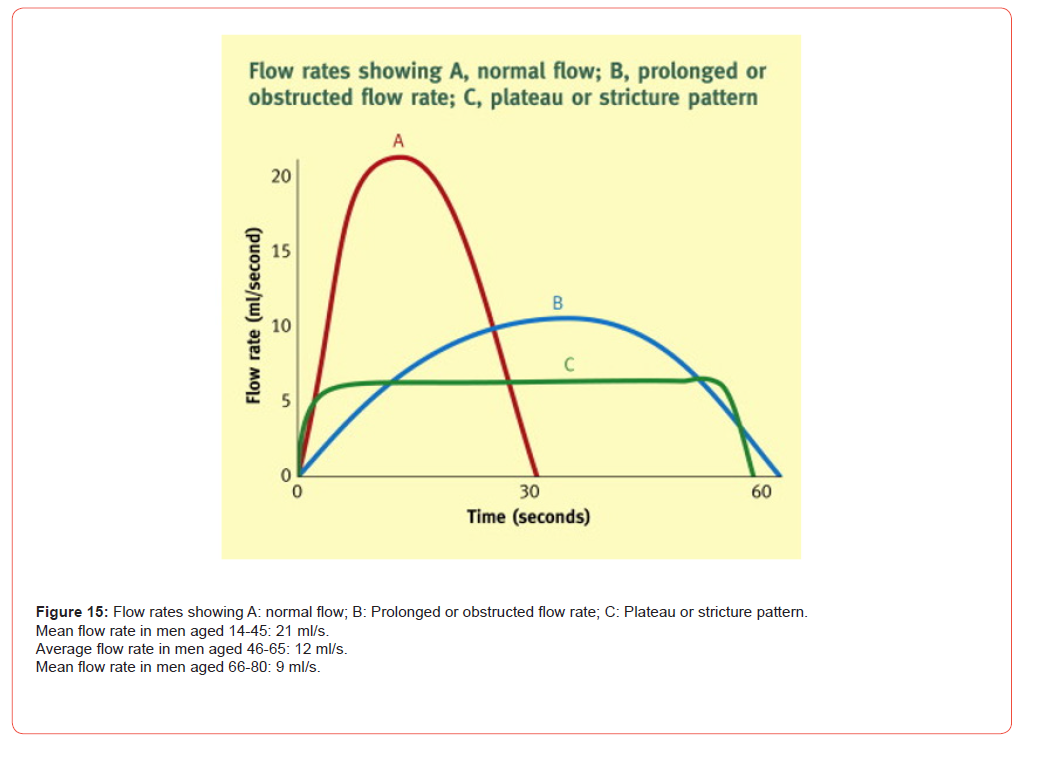 Click here to view Large Figure 15 irispublishers-openaccess-urology-nephrology