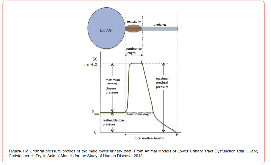 Click here to view Large Figure 16 irispublishers-openaccess-urology-nephrology