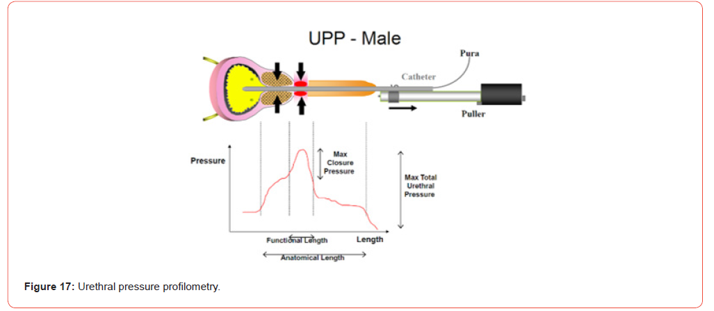 Click here to view Large Figure 17 irispublishers-openaccess-urology-nephrology