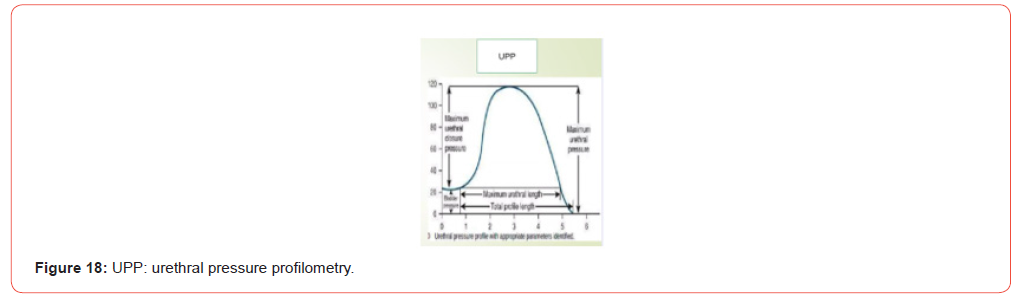 Click here to view Large Figure 18 irispublishers-openaccess-urology-nephrology