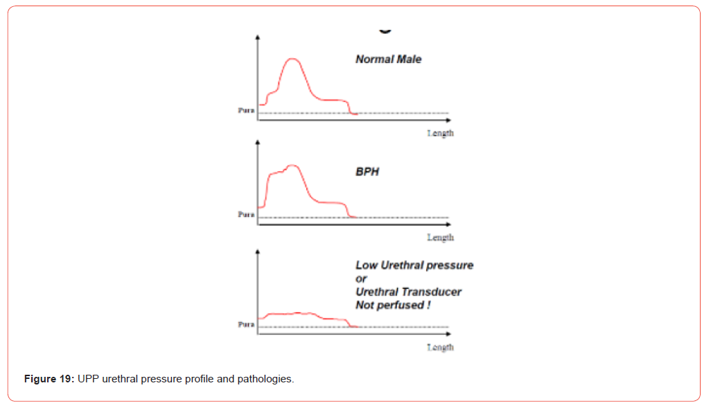 Click here to view Large Figure 19 irispublishers-openaccess-urology-nephrology