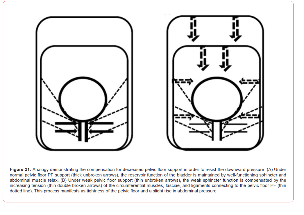 Click here to view Large Figure 21 irispublishers-openaccess-urology-nephrology