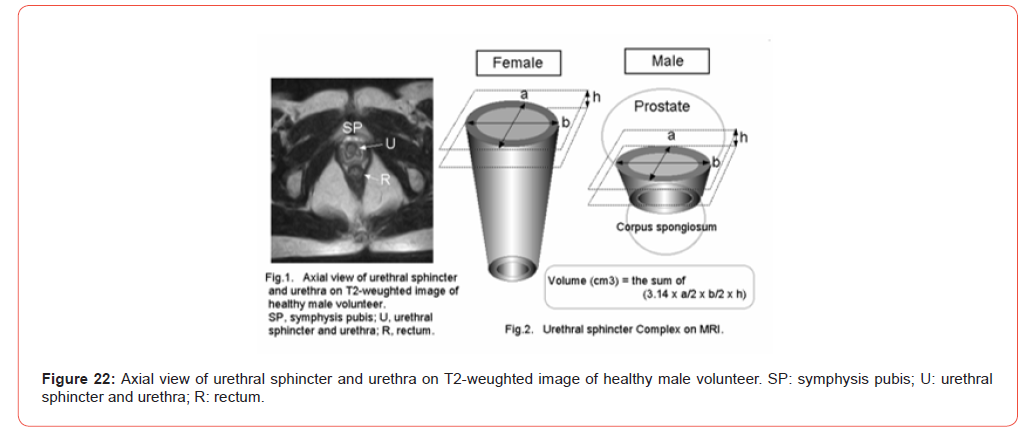 Click here to view Large Figure 22 irispublishers-openaccess-urology-nephrology