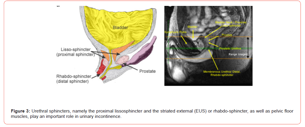 Click here to view Large Figure 3 irispublishers-openaccess-urology-nephrology