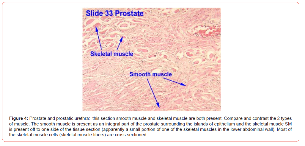 Click here to view Large Figure 4 irispublishers-openaccess-urology-nephrology
