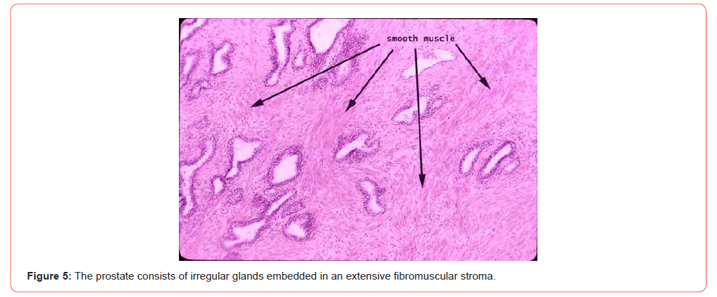 Click here to view Large Figure 5 irispublishers-openaccess-urology-nephrology