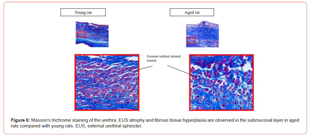 Click here to view Large Figure 6 irispublishers-openaccess-urology-nephrology