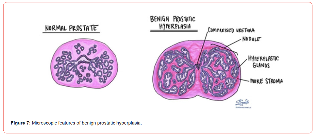 Click here to view Large Figure 7 irispublishers-openaccess-urology-nephrology
