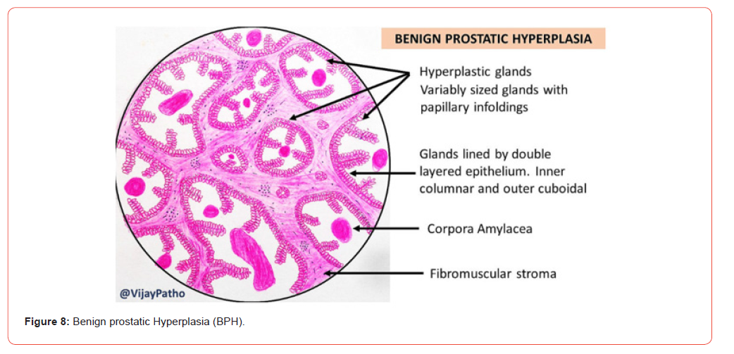 Click here to view Large Figure 8 irispublishers-openaccess-urology-nephrology