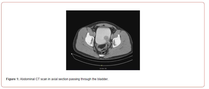 Click here to view Large Figure 1 irispublishers-openaccess-urology-nephrology