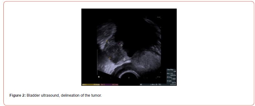 Click here to view Large Figure 2 irispublishers-openaccess-urology-nephrology