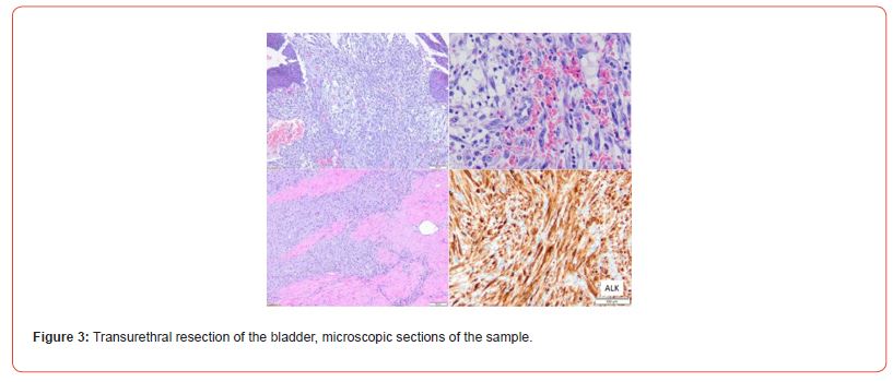 Click here to view Large Figure 3 irispublishers-openaccess-urology-nephrology