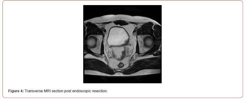Click here to view Large Figure 4 irispublishers-openaccess-urology-nephrology