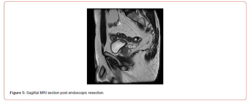Click here to view Large Figure 5 irispublishers-openaccess-urology-nephrology