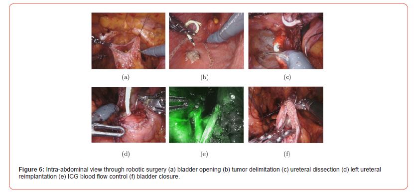 Click here to view Large Figure 6 irispublishers-openaccess-urology-nephrology