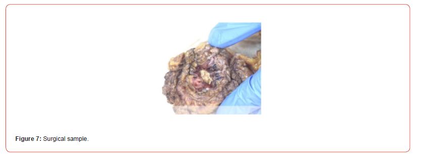 Click here to view Large Figure 7 irispublishers-openaccess-urology-nephrology