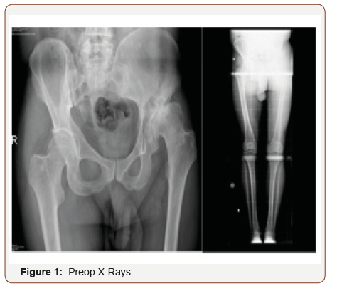 irispublishers-openaccess-orthopedics-research