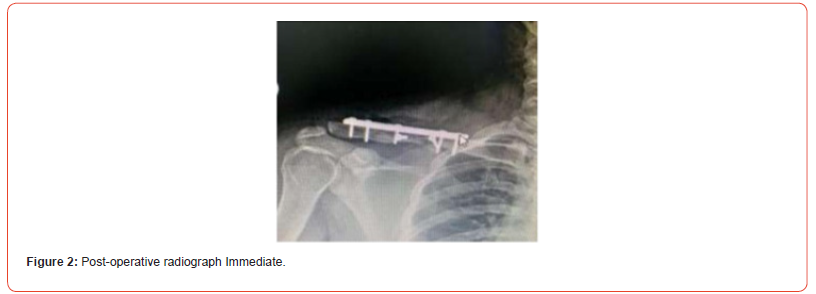 Click here to view Large Figure 2 irispublishers-openaccess-orthopedics-research