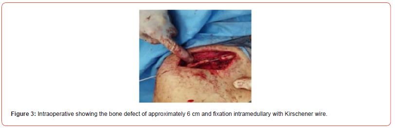 Click here to view Large Figure 3 irispublishers-openaccess-orthopedics-research