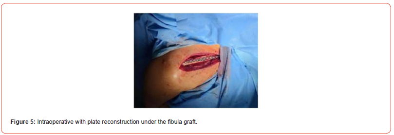 Click here to view Large Figure 5 irispublishers-openaccess-orthopedics-research