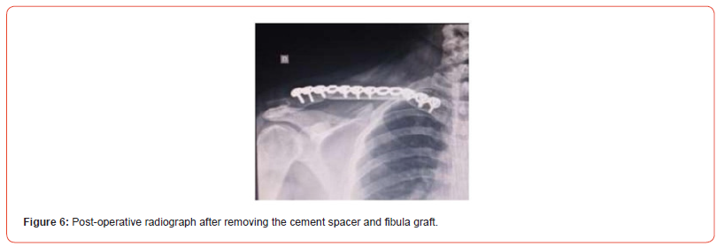 Click here to view Large Figure 6 irispublishers-openaccess-orthopedics-research
