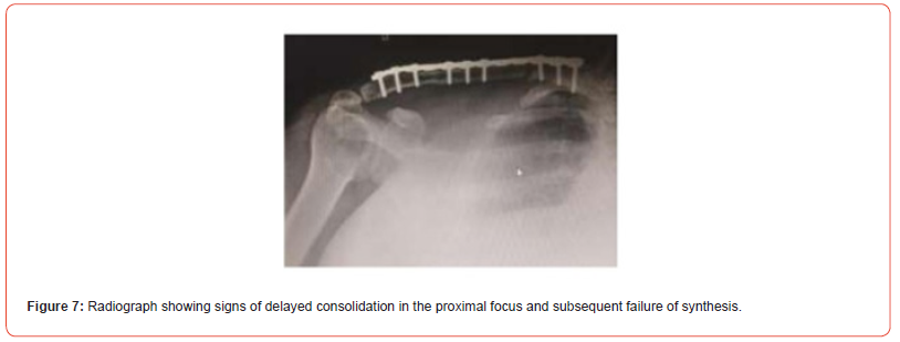 Click here to view Large Figure 7 irispublishers-openaccess-orthopedics-research
