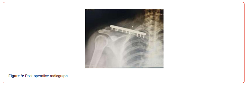 Click here to view Large Figure 9 irispublishers-openaccess-orthopedics-research