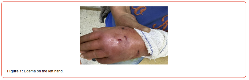 Click here to view Large Figure 1 irispublishers-openaccess-orthopedics-research