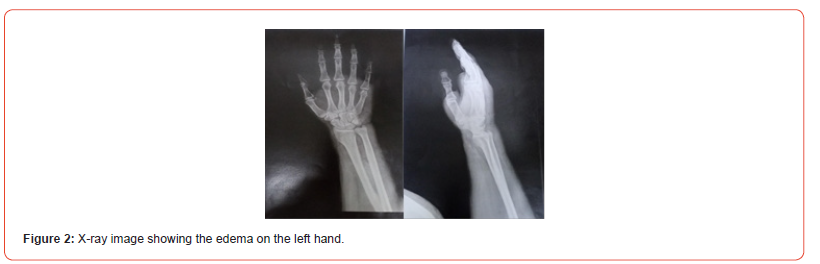 Click here to view Large Figure 2 irispublishers-openaccess-orthopedics-research