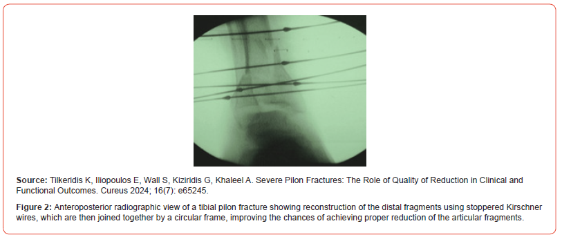 Click here to view Large Figure 2 irispublishers-openaccess-orthopedics-research