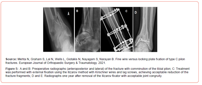 Click here to view Large Figure 5 irispublishers-openaccess-orthopedics-research