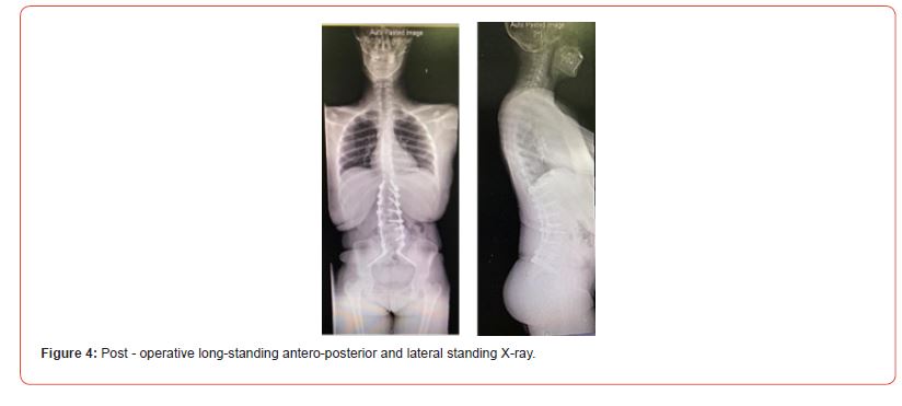 Click here to view Large Figure 4 irispublishers-openaccess-orthopedics-research