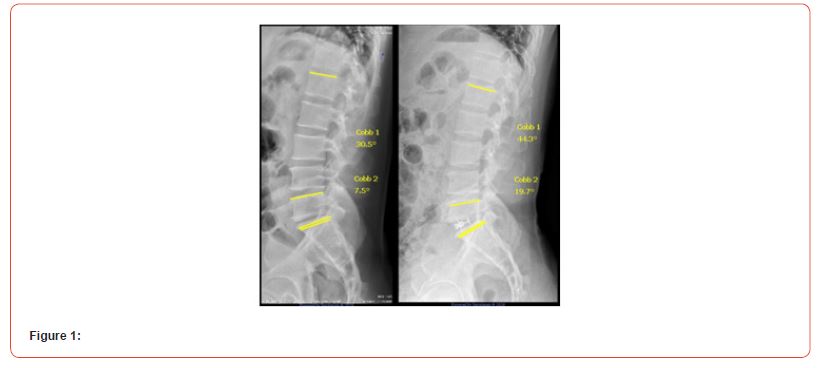 Click here to view Large Figure 1 irispublishers-openaccess-orthopedics-research
