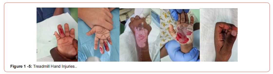 Click here to view Large Figure 1 irispublishers-openaccess-orthopedics-research