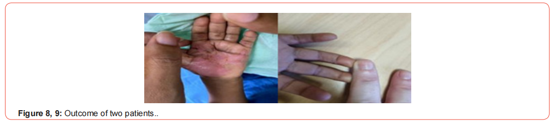 Click here to view Large Figure 3 irispublishers-openaccess-orthopedics-research